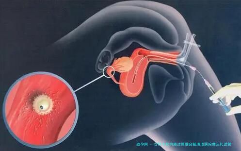 女性子宫内膜过厚烟台毓璜顶医院做三代试管预算八万块够不够？