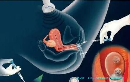 上海三代试管婴儿医院排名哪家好？