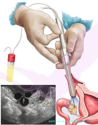 2026年去泰国DHC生殖中心做三代试管整体费用是多少？
